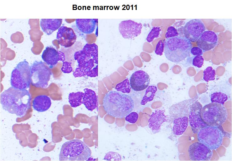 Figure 4. Composite images showing dysmyelopoiesis in marrow aspirate smear in 2011.